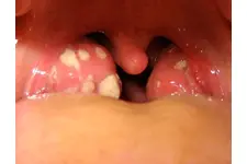 Bebeklerde Boğaz Enfeksiyonuna Ne İyi Gelir?