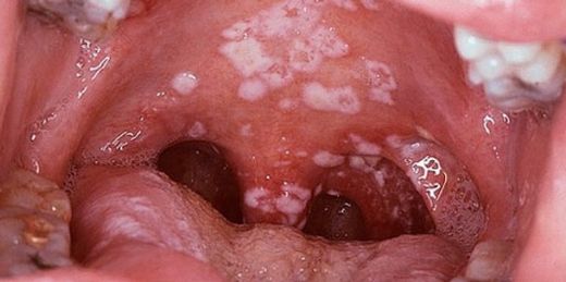 Ağız Enfeksiyonu Belirtileri ve Tedavisi