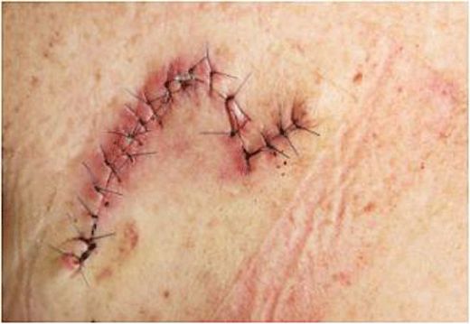 Ameliyat Enfeksiyonu Belirtileri ve Tedavisi