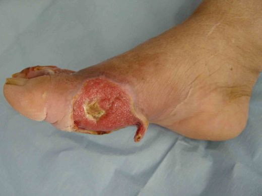 Ayak Enfeksiyonu Belirtileri ve Tedavisi