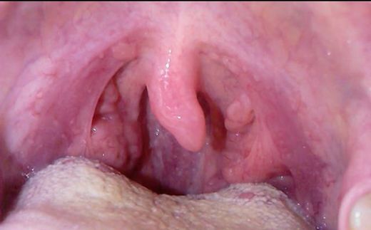 Geçmeyen Boğaz Enfeksiyonu Belirtileri ve Tedavisi