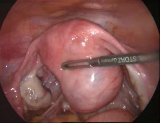 İdrar Yolu Enfeksiyonu Ameliyatı Riskleri ve Sonrası