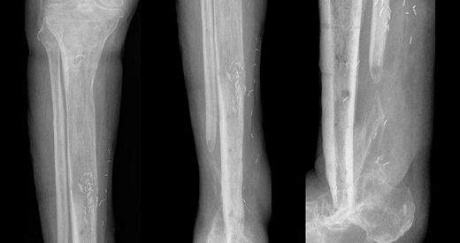 Kemik Enfeksiyonu Belirtileri ve Tedavisi