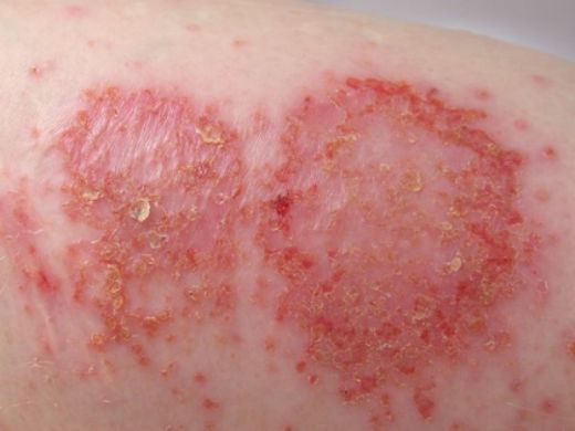 Mantar Enfeksiyonu Belirtileri ve Tedavisi