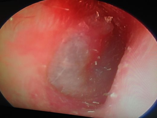 Orta Kulak Enfeksiyonu Belirtileri ve Tedavisi