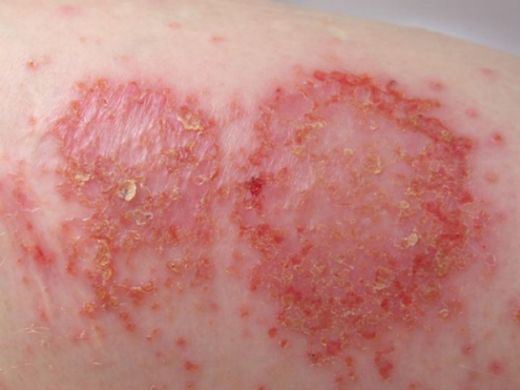 Vücutta Enfeksiyon Belirtileri ve Tedavisi